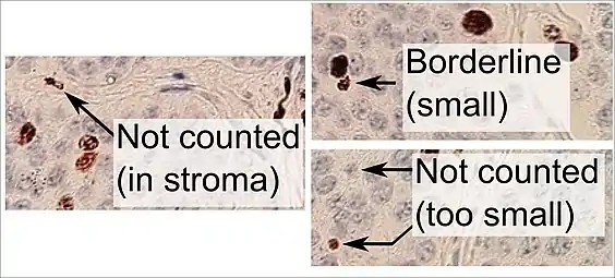 Recuento de núcleos positivos frente a negativos con marcaje Ki-67, en este caso en un tumor neuroendocrino de intestino delgado. Para contar como positivo, un núcleo debe tener una tinción oscura homogénea (no solo punteada), al menos la mitad dentro del campo de visión, ser lo suficientemente grande y no estar ubicado en el estroma.