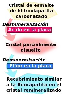 El cristal del esmalte de hydroxyapatita carbonatada es desmineralizado por el ácido en la plaqueta y se convierte en un cristal parcialmente disuelto. A su vez, éste es remineralizado por el fluoruro en la placa para convertirse en un revestimiento similar a la fluorapatita en el cristal remineralizado.