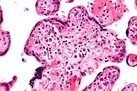 Villitis crónica de alto grado